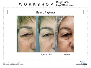 Blefaro Raytrace
Após 30 dias 11 meses
 