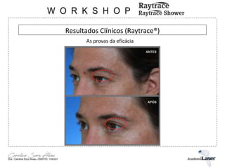 Resultados Clínicos (Raytrace®)
As provas da eficácia
 