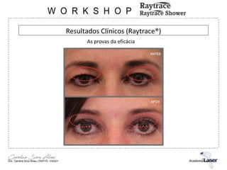 Resultados Clínicos (Raytrace®)
As provas da eficácia
 