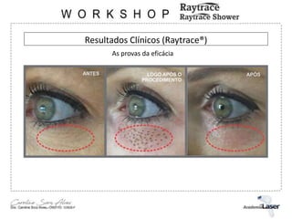 Resultados Clínicos (Raytrace®)
As provas da eficácia
 