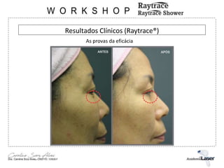 Resultados Clínicos (Raytrace®)
As provas da eficácia
 
