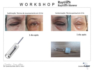 Sublimação: Técnica de escaneamento em 15 Hz Carbonização: Técnica pontual em 2 Hz
1 dia após 1 dia após
 