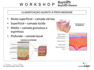 CLASSIFICAÇÃO QUANTO À PROFUNDIDADE
• Muito superficial – camada córnea
• Superficial – camada lúcida
• Médio – camada granulosa e
espinhosa
• Profundo – camada basal
 