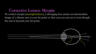 Corrective Lenses: Myopia
To correct myopia (nearsightedness), a diverging lens creates an intermediate
image of a distant star at your far point so that your eye can see it even though
the star is beyond your far point.
 