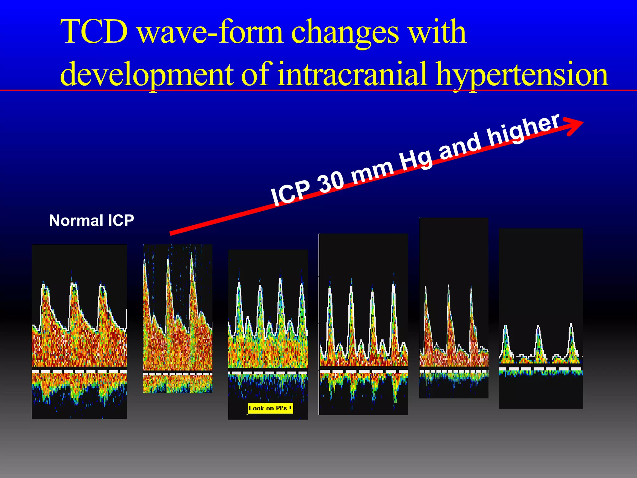 TCD wave-form changes with
 development of intracranial hypertension


Normal ICP
 