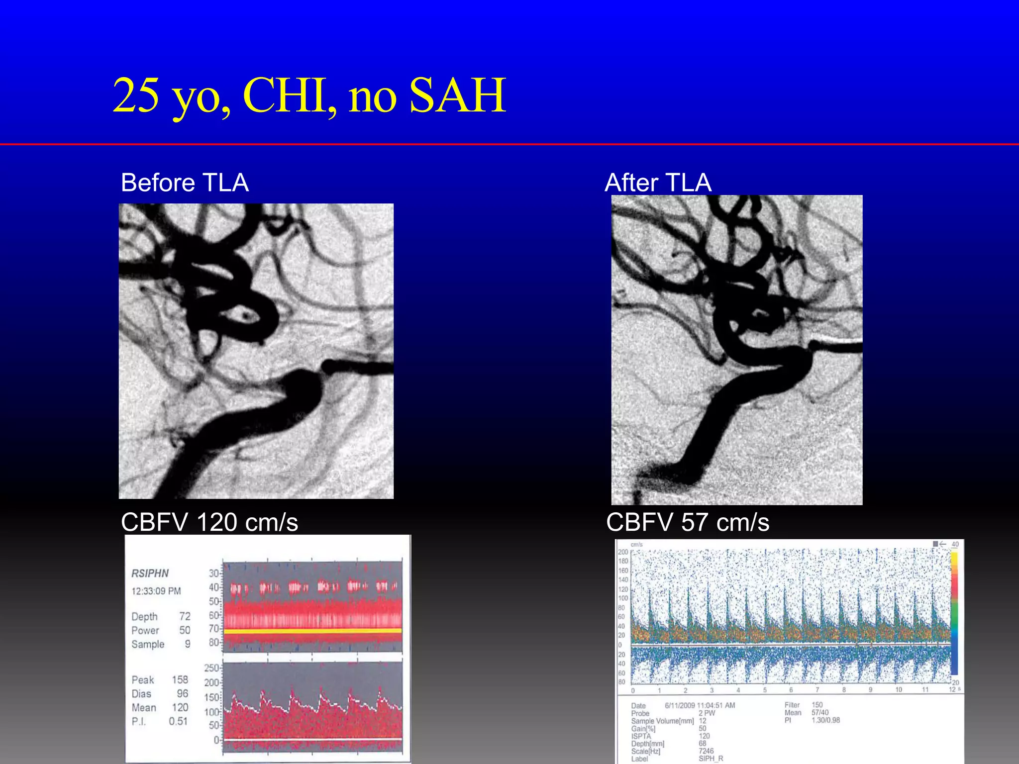 25 yo, CHI, no SAH
Before TLA           After TLA




CBFV 120 cm/s        CBFV 57 cm/s
 
