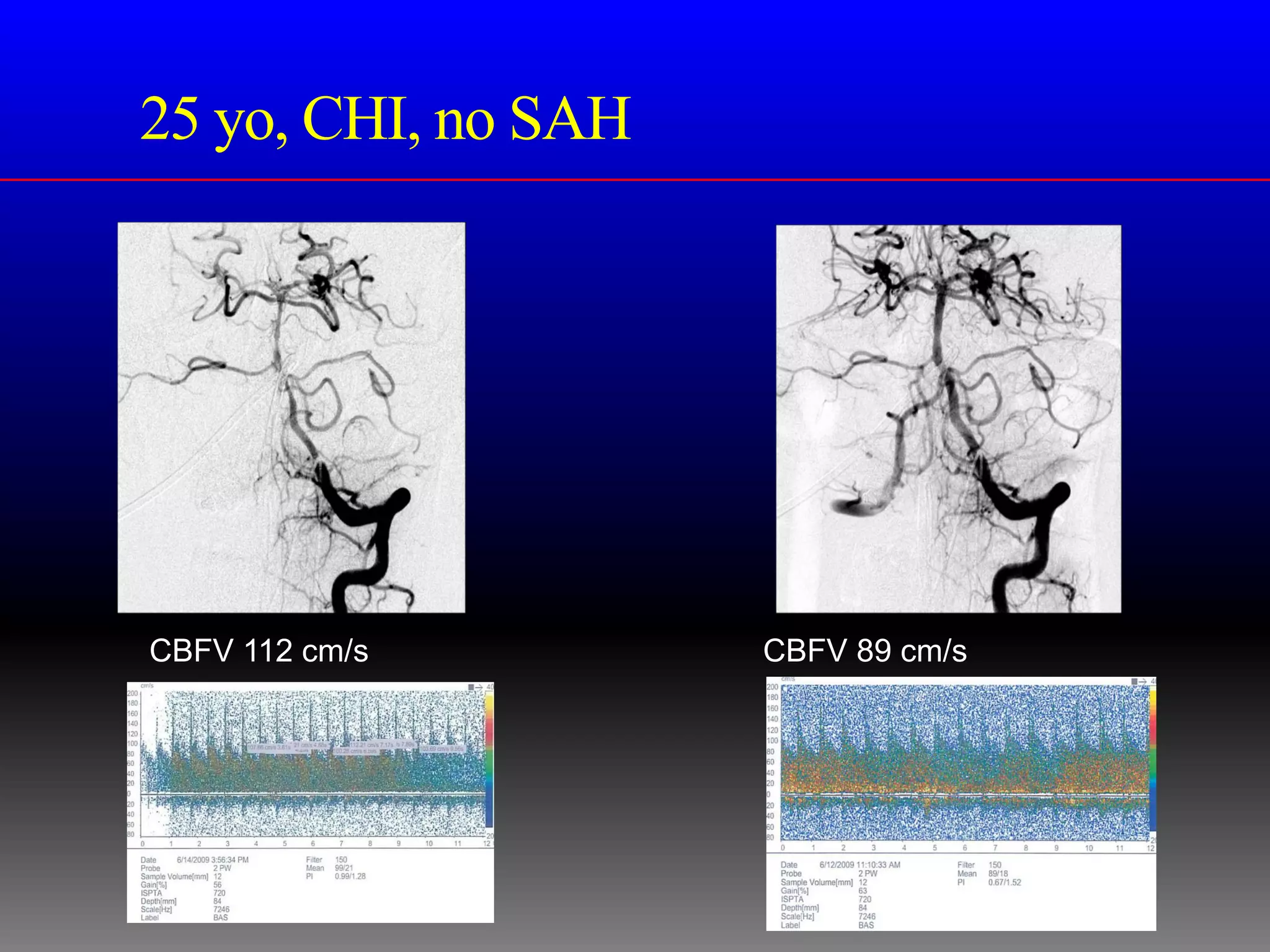 25 yo, CHI, no SAH




CBFV 112 cm/s        CBFV 89 cm/s
 