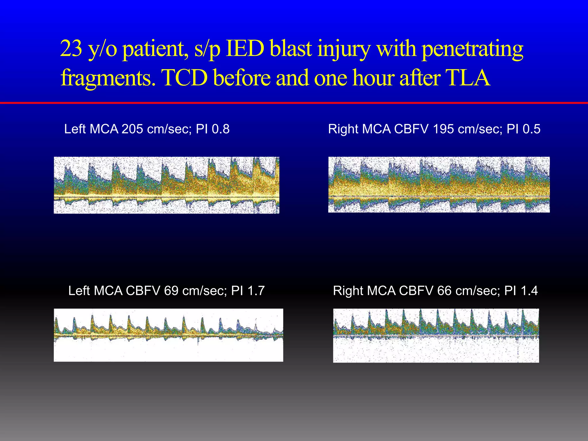 23 y/o patient, s/p IED blast injury with penetrating
fragments. TCD before and one hour after TLA
Left MCA 205 cm/sec; PI 0.8       Right MCA CBFV 195 cm/sec; PI 0.5




Left MCA CBFV 69 cm/sec; PI 1.7   Right MCA CBFV 66 cm/sec; PI 1.4
 