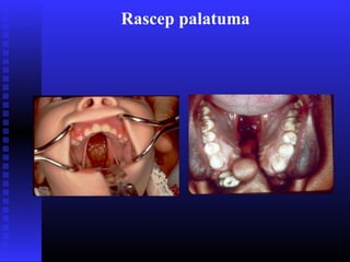 Rascep palatuma
 