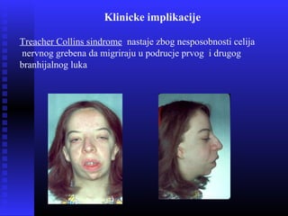 Klinicke implikacije
Treacher Collins sindrome nastaje zbog nesposobnosti celija
nervnog grebena da migriraju u podrucje prvog i drugog
branhijalnog luka
 