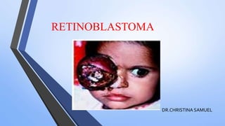 RETINOBLASTOMA
DR.CHRISTINA SAMUEL
 