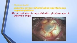 • Phthisis bulbi
undergo severe inflammation-spontaneous
regress-phthisis
RB to considered in any child with phthisical eye of
uncertain origin
 