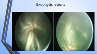 Exophytic lesions
 