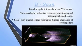 B - Scan
Round irregular intraocular mass, V-Y pattern.
Numerous highly reflective echoes-representing typical
intralesional calcification.
A-Scan- high internal echoes with tumor & rapid attenuation of
orbital pattern
 
