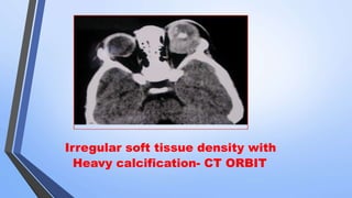Irregular soft tissue density with
Heavy calcification- CT ORBIT
 
