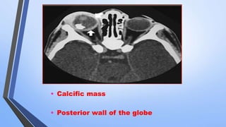 • Calcific mass
• Posterior wall of the globe
 