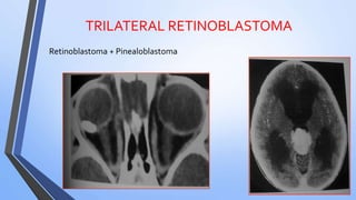 TRILATERAL RETINOBLASTOMA
Retinoblastoma + Pinealoblastoma
 