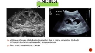 Pyonephrosis Uss Genitourinary Radiology MD USM (15/20) | PPTX