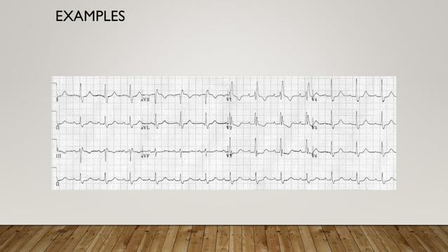 right bundle branch block ,rbbb,right heart failure | PDF