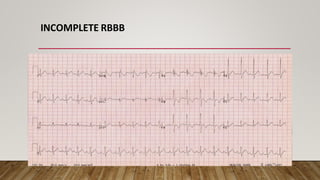INCOMPLETE RBBB
 