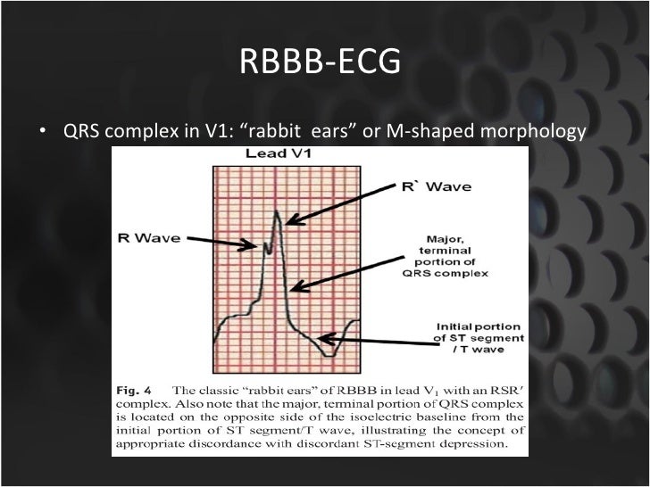 rbbb ecg