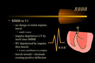 Rbbb final | PPT