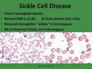 Sickle Cell Disease Classic hemoglobinopathy Normal HGB is  α 2  β 2:  β -chain defects (Val->Glu) Reduced hemoglobin “sickles” in homozygous 8% of American blacks are heterozygous www.freelivedoctor.com 