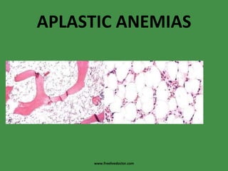 APLASTIC ANEMIAS www.freelivedoctor.com 