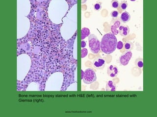 www.freelivedoctor.com Bone marrow biopsy stained with H&E (left), and smear stained with Giemsa (right).  