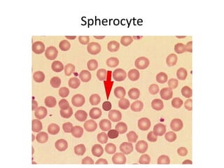 Spirocyte Rbc Rbc disorders 1 | PDF