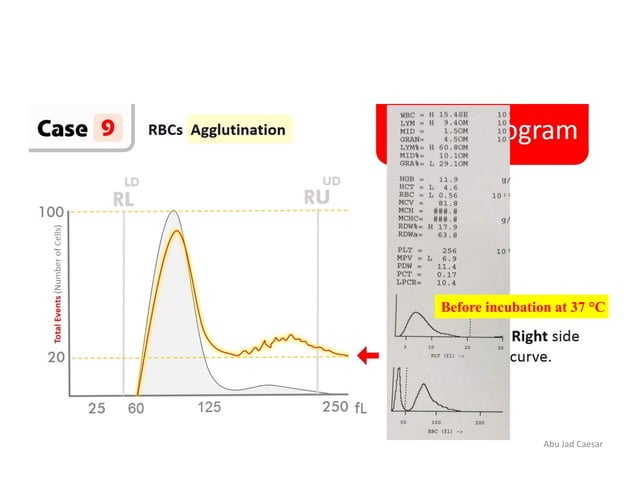 Abnormal Rbc Histogram , Interpretation of histograms – LMKTZU