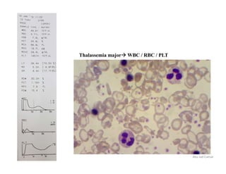 Thalassemia major WBC / RBC / PLT
Abu Jad Caesar