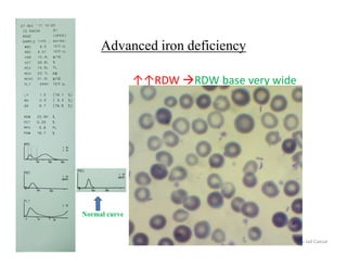 Advanced iron deficiency
↑↑RDW RDW base very wide
Abu Jad Caesar
Normal curve