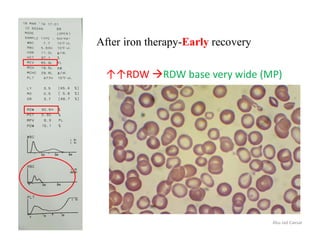 After iron therapy-Early recovery
Abu Jad Caesar
↑↑RDW RDW base very wide (MP)