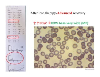 After iron therapy-Advanced recovery
Abu Jad Caesar
↑↑RDW RDW base very wide (MP)