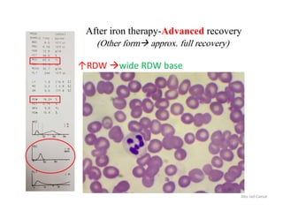 After iron therapy-Advanced recovery
(Other form approx. full recovery)
Abu Jad Caesar
↑RDW wide RDW base