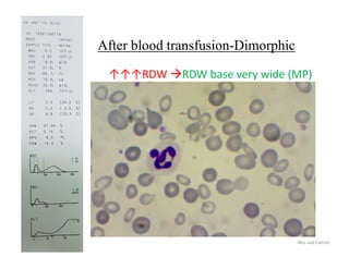 After blood transfusion-Dimorphic
↑↑↑RDW RDW base very wide (MP)
Abu Jad Caesar