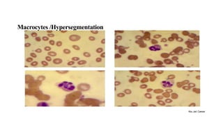 RBC HISTOGRAM and cell blood counts.pptx