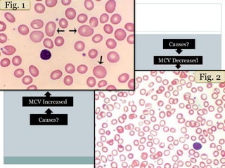 High Mcv Algorithm Rbc indices | PPTX