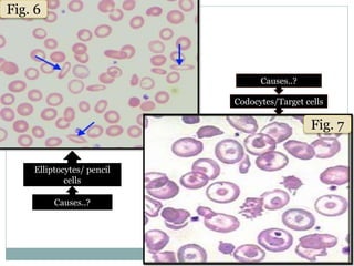 Codocyte Rbc Rbc indices | PPTX