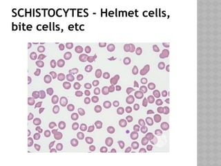 SCHISTOCYTES - Helmet cells,
bite cells, etc
 