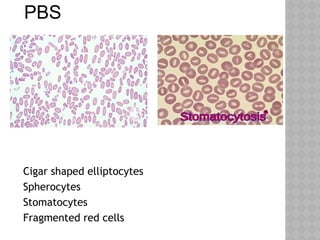 PBS
Cigar shaped elliptocytes
Spherocytes
Stomatocytes
Fragmented red cells
 