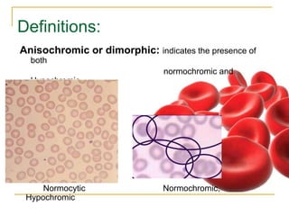 RBC morphology and Disease that may be associated with abnormal ...