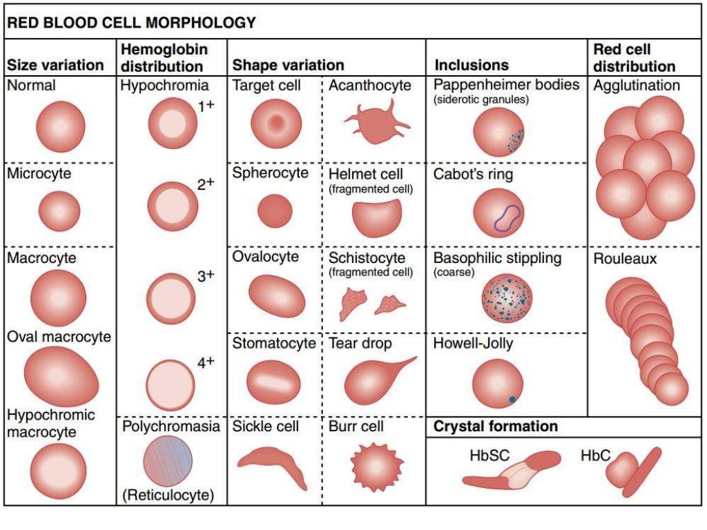 RBC morphology and Disease that may be associated with abnormal morph…