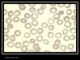 Monomorphic Rbc Rbc morphology | PPT