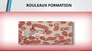 True Rouleaux Rbc RBC Nursing.pptx........................ | PPTX