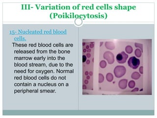 Variation In Rbc Shape RBC & WBC abnormalities and their interpretation | PPTX