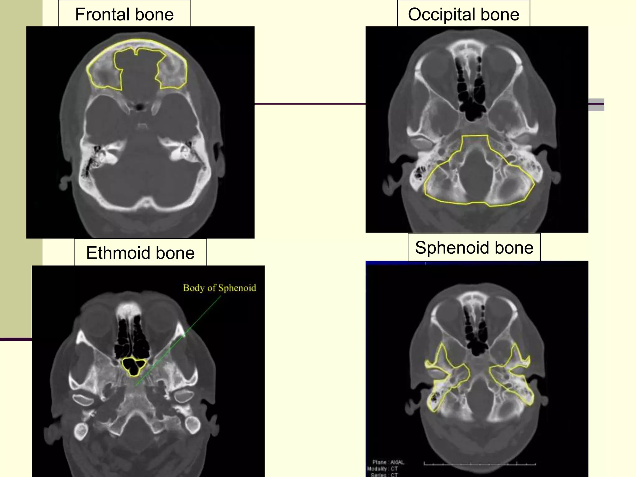 (R)brain ct anatomy (1) | PPT