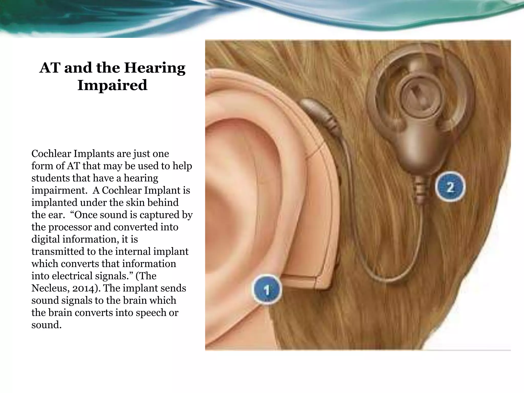 AT and the Hearing 
Impaired 
Cochlear Implants are just one 
form of AT that may be used to help 
students that have a hearing 
impairment. A Cochlear Implant is 
implanted under the skin behind 
the ear. “Once sound is captured by 
the processor and converted into 
digital information, it is 
transmitted to the internal implant 
which converts that information 
into electrical signals.” (The 
Necleus, 2014). The implant sends 
sound signals to the brain which 
the brain converts into speech or 
sound. 
 