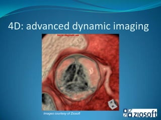 Images beyondradiology:  oncologyIntegration of imaging in planning & monitoring cancer treatmentsfunctional imaging: CT/MRI diffusion and perfusion, PET-CT, PET-MRI(Automated )quantitative imaging methods (staging , F.U., early response)Integration of interventional radiology  & surgeryTACE, RFA, radio-embolisation, cryo-ablation, micro-wave ablation...followed by surgery (e.g. liver)preoperative strategy planning with automated 3D segmentation e.g. liver, breast – new developments arFraunhofer MEVISIntegration with radiotherapy: IGRT with dynamic targetingCT and even MRIIntegration with chemotherapyMRI-guided chemo (temperature-induced drug release)